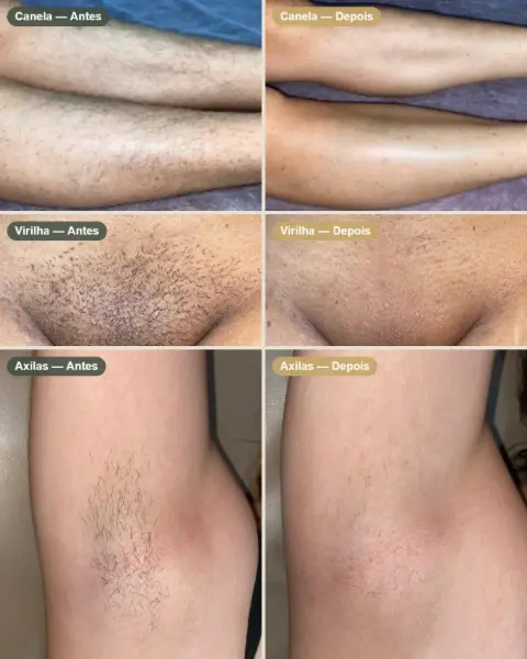 Antes e depois de sessões de depilação a laser na Pilare
