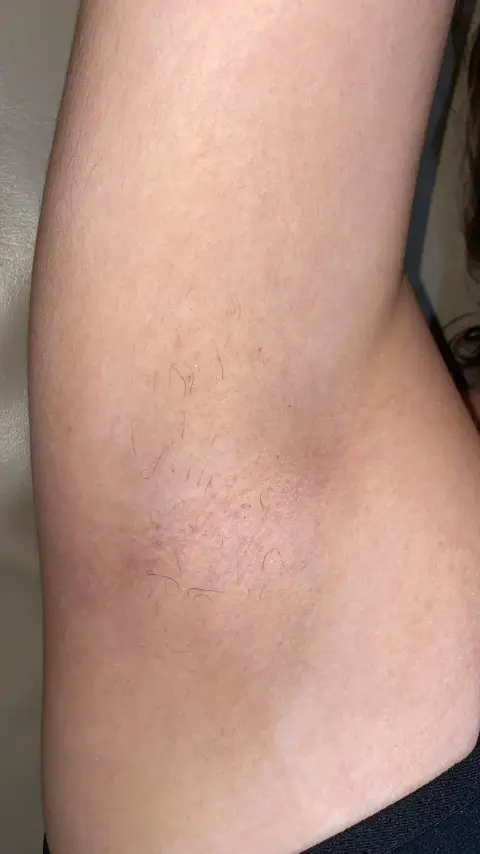 Axila depois da depilação a laser