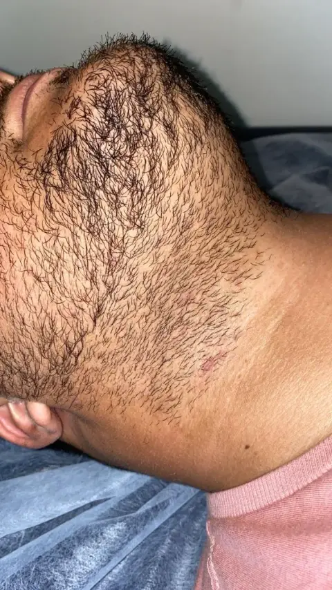 Faixa de barba antes da depilação a laser