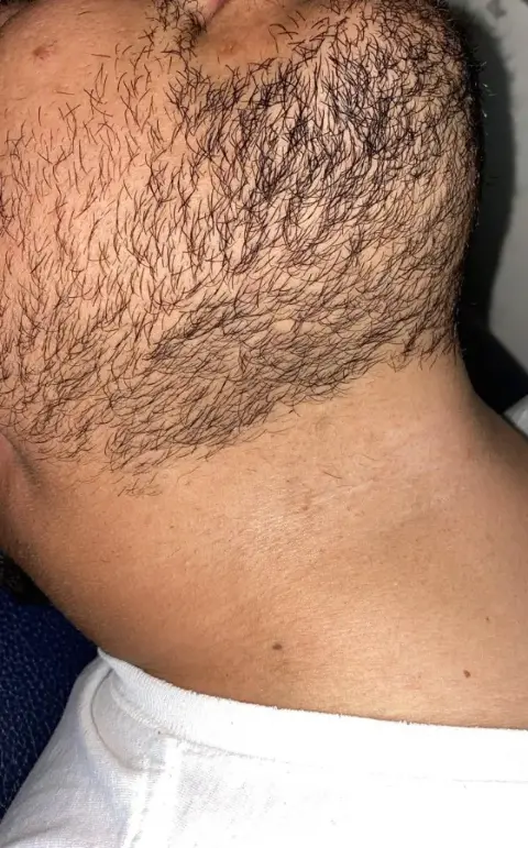 Faixa de barba depois da depilação a laser