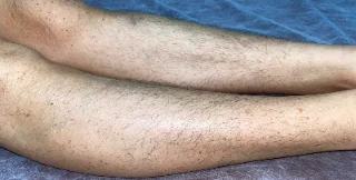Canela antes da depilação a laser
