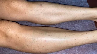 Canela depois da depilação a laser