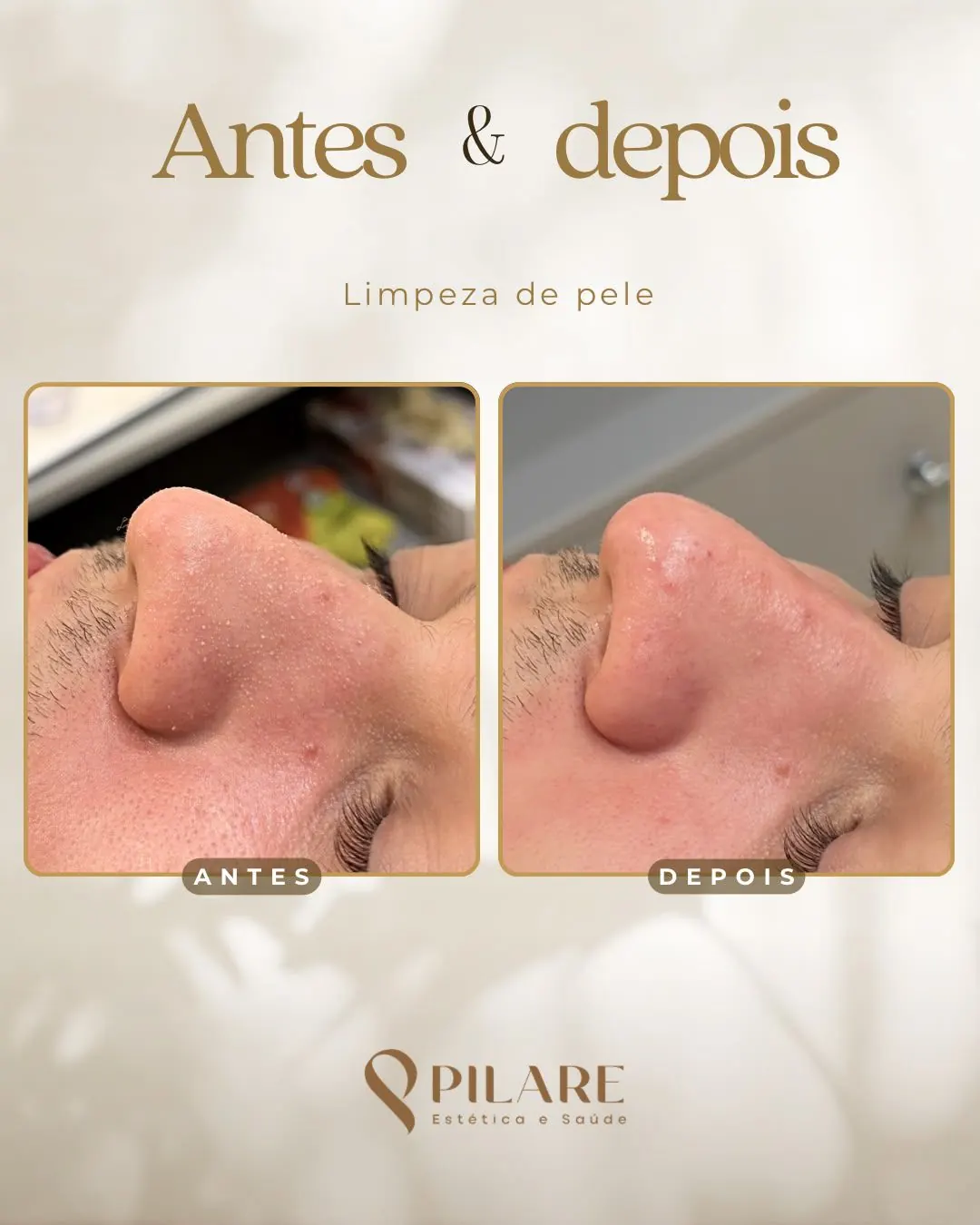 Antes e depois de limpeza de pele realizada na Clínica Pilare