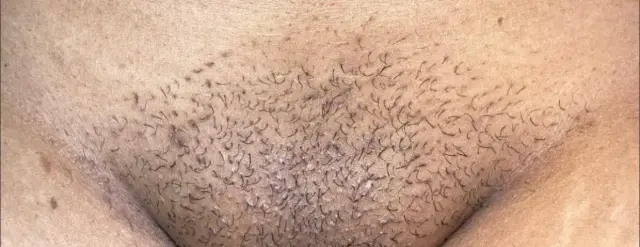 Virilha antes da depilação a laser