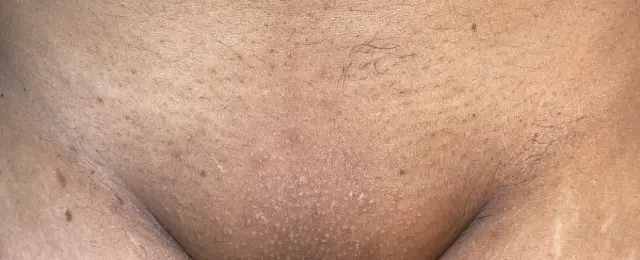 Virilha depois da depilação a laser